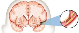 Illustration for article titled Obat Stroke Dari Tumbuhan